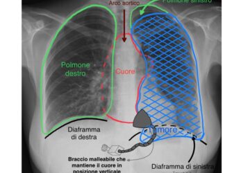 La massa di venti centimetri al timo comprimeva anche un polmone